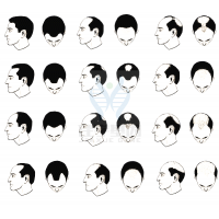 【佳学基因检测】过早脱发、掉发太多怎么办?你的方法可能是错的! 【佳学基因检测】过早脱发、掉发太多怎么办?你的方法可能是错的!