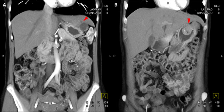 【佳学基因检测】Carney-Stratakis综合征遗传阻断基因检测