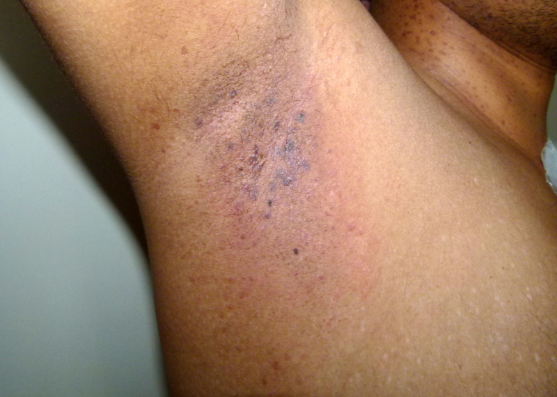 【佳学基因检测】黑点病基因检测(Dark dot disease) 【佳学基因检测】黑点病基因检测(Dark dot disease)