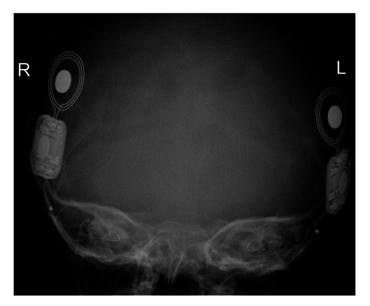 【佳学基因检测】唐奈-巴罗综合征基因检测(DBS)及其治疗 【佳学基因检测】唐奈-巴罗综合征基因检测(DBS)及其治疗
