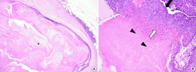 【佳学基因检测】巨大毛母质瘤的基因检测案例 【佳学基因检测】巨大毛母质瘤的基因检测案例