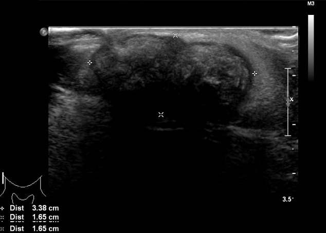 【佳学基因检测】巨大毛母质瘤的基因检测案例 【佳学基因检测】巨大毛母质瘤的基因检测案例