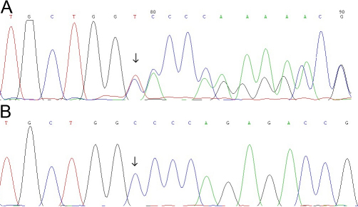 【佳学基因检测】睑裂狭小综合征1型基因解码、基因检测的报告有人解读吗？