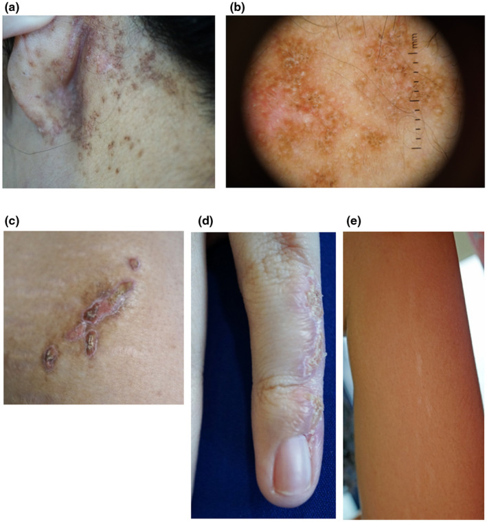 【佳学基因检测】CHILD综合征基因解码、基因检测有什么用? 【佳学基因检测】CHILD综合征基因解码、基因检测有什么用?