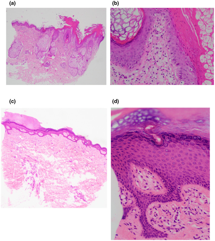 【佳学基因检测】CHILD综合征基因解码、基因检测有什么用? 【佳学基因检测】CHILD综合征基因解码、基因检测有什么用?