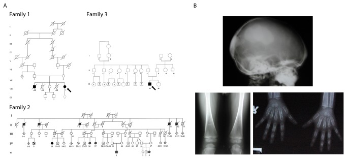 【佳学基因检测】常染色体隐性颅骨干骺端发育不良基因解码、基因检测 【佳学基因检测】常染色体隐性颅骨干骺端发育不良基因解码、基因检测