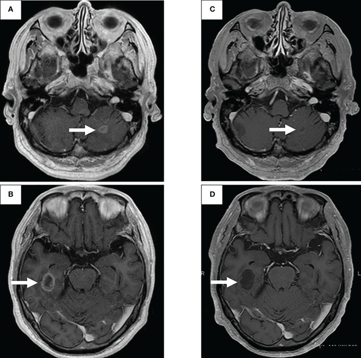 【佳学基因检测】肺癌靶向药物基因检测为什么要包含RET重排
