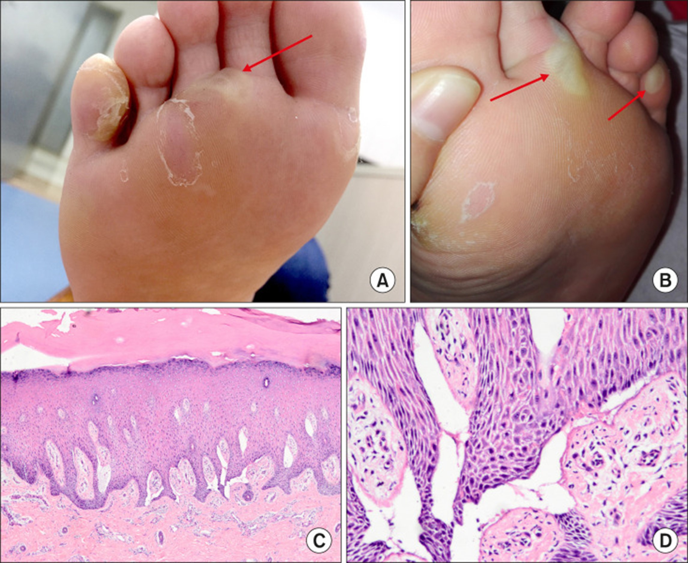 【佳学基因检测】单纯性大疱性表皮松解症基因检测Epidermolysis bullosa simplex