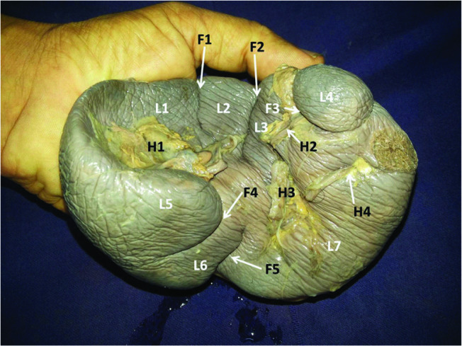【佳学基因检测】分叶脾/多叶脾基因检测 Multilobulated spleen 【佳学基因检测】分叶脾/多叶脾基因检测 Multilobulated spleen