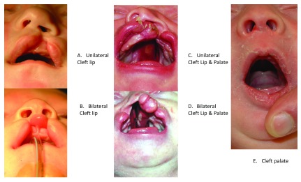 【佳学基因检测】唇裂、腭裂、唇腭裂遗传吗?如何阻断? 【佳学基因检测】唇裂、腭裂、唇腭裂遗传吗?如何阻断?