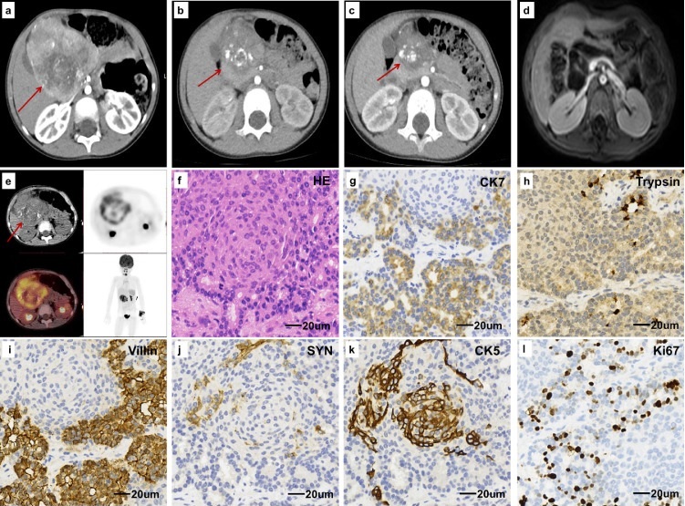 【佳学基因检测】胰腺母细胞瘤基因检测 【佳学基因检测】胰腺母细胞瘤基因检测